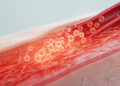 Stem Cell Transplantation Eases Skin Inflammation in Systemic Sclerosis
