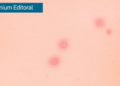 Skin Microbiome Shifts Confirmed as Central Driver of Eczema in Landmark Meta-Analysis