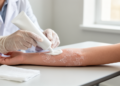 Investigational Lotion QRX003 Shows Early Promise in Netherton Syndrome Case