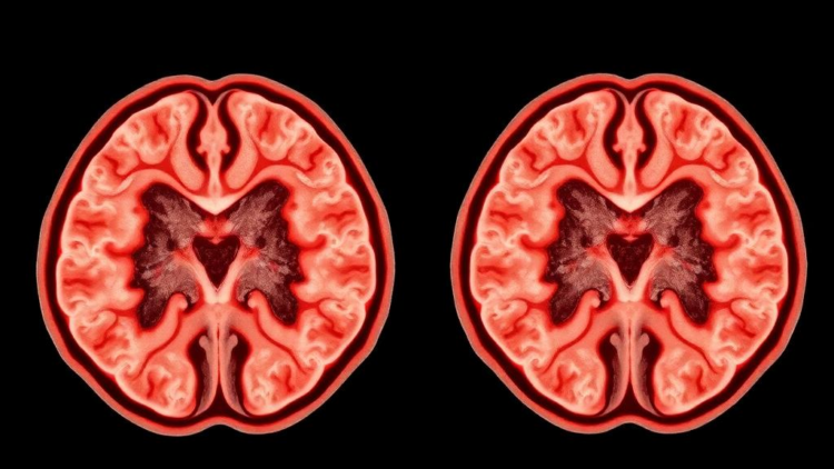 Two Cancer Genes Pull in Opposite Directions in Papillary Thyroid Tumors