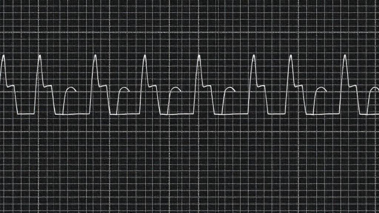 EEG Slow-Wave Patterns Track Oxcarbazepine Response in Focal Epilepsy