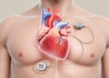 Right-Sided Heart Pacemaker Lead With Chest Tunneling Offers Salvage When Main Vein Is Blocked