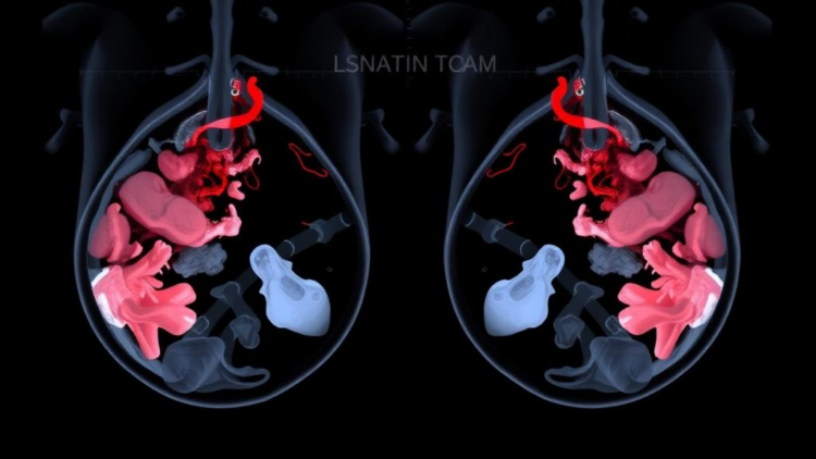 Tomosynthesis cuts interval breast cancers by a quarter in major screening trial