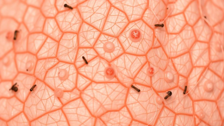Itch-scratch cycle in lichen simplex chronicus calls for combined drug and non-drug treatment strategies