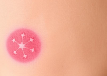 Squamous Cell Carcinoma Tops Skin Cancer Diagnoses in Five-Year Kabul Study