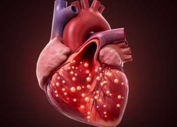 ICI Myocarditis Complicated by HOCM and NSTEMI in Cancer Patient