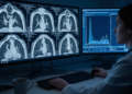 CT Radiomics Adds Nothing Over Tumor Volume for Early Immunotherapy Response