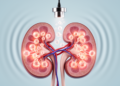 Gentle Ultrasound and Microbubbles Repair Diabetic Kidney Damage in Mice