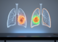 U-Net Variants Compared for Automated Lung Tumor Segmentation on CT Scans