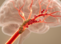 Stroke begins years earlier: vascular dysfunction offers a window for prevention