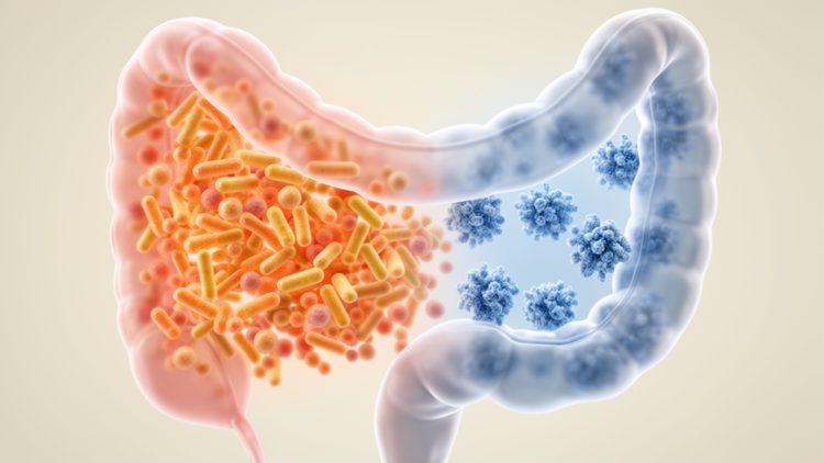 Gut Dysbiosis Signatures Found in Five Newborns With Complex Surgical and Urological Conditions