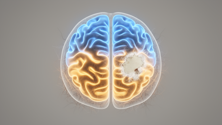 Stroke Disrupts Brain Rhythms on Both Sides in Rat Motor Cortex