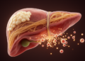 Blood vesicle proteins flag advanced scarring in fatty liver disease