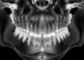 Hidden Extra Teeth: How 3D Imaging Is Changing Surgery for Childhood Mesiodens