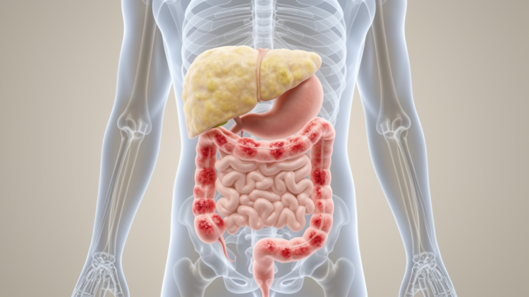 Colitis and Colon Lesions Found in 40% of Obese Patients with Liver Steatosis