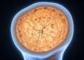 Bone Damage Runs Deep in Cushing's Syndrome, Even When Scans Look Normal