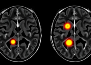 Double Inversion Recovery MRI Spots More Spinal Cord Lesions in Multiple Sclerosis