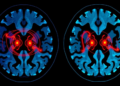 Dual-Key Chaotic Encryption Targets Critical Regions of Medical CT Images