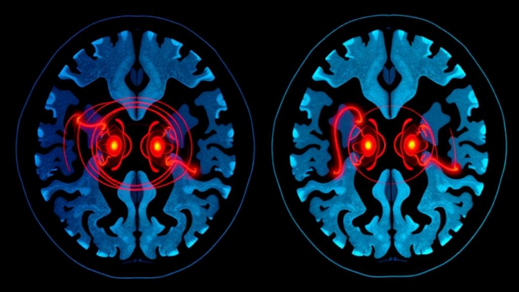 Dual-Key Chaotic Encryption Targets Critical Regions of Medical CT Images