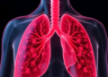 Rare inherited MUC16 variants may underlie multiple lung cancers in one family