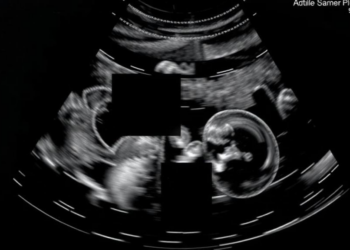 Venous Congestion Ultrasound: Doppler Signs That Track Organ Fluid Overload