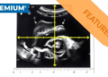 Quantitative Ultrasound Cervix Measurements Show Moderate Reliability in Pregnancy Study
