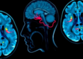 Rare Brainstem Death Case Shows Preserved Supratentorial Perfusion on Brain Scan