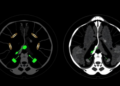 Dual-Tracer PET/CT Imaging Linked to Tumor Aggressiveness in Liver Cancer