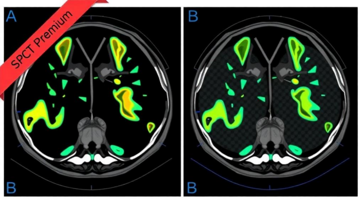 Threshold-Based Segmentation Outperforms Gradient Methods for Tracking Tumour Volume on Lu-177 PSMA SPECT/CT
