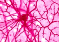 Tumor-Infiltrating Lymphocytes and Microvessel Density Together Predict Breast Cancer Prognosis