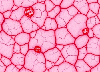 Rare Sarcoma Arising From Castleman Disease Tied to Pemphigus and Poor Survival