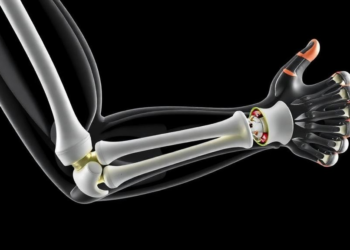 Radial Head Implants Restore Stiffness in Complex Elbow Fracture Model