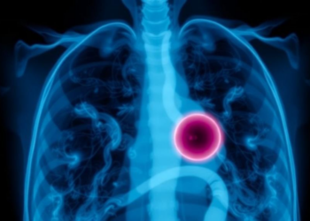 Benign Tumor at a Lung Surgery Port Site Fooled Doctors Into Fearing Cancer Recurrence