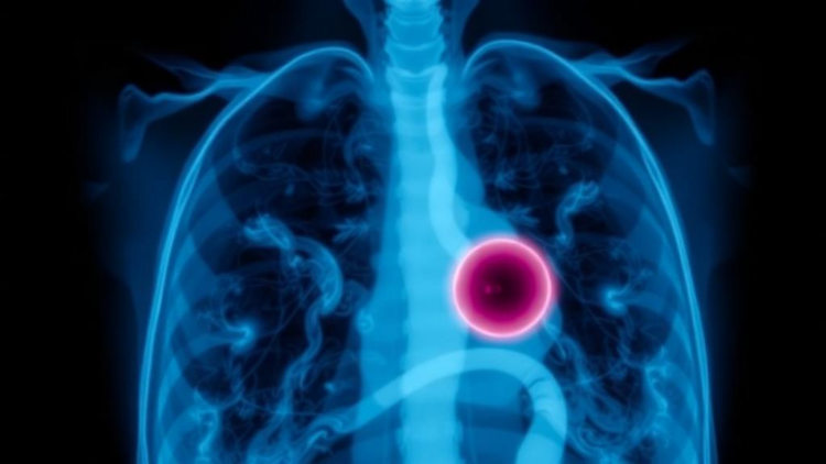 Benign Tumor at a Lung Surgery Port Site Fooled Doctors Into Fearing Cancer Recurrence
