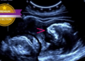 Bedside Ultrasound Confirms Central Line Tip Position Faster Than Chest X-Ray