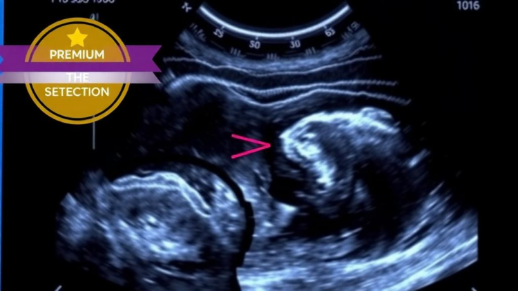 Bedside Ultrasound Confirms Central Line Tip Position Faster Than Chest X-Ray