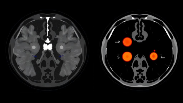PET/CT Scans After CAR T-Cell Therapy Track Response in Korean Lymphoma Patients