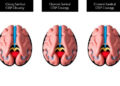 Three CSF Drainage Strategies Show Similar Clot Clearance in Brain Haemorrhage Study