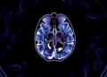 Prostate Cancer Detection Rose After MRI Arrived, But a Single-Centre Study Says the Reason Stays Unclear