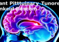 Giant Pituitary Tumors Linked to Higher Risk of Postoperative Stroke