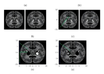 Ensemble AI Reads Brain MRI With Adaptive Attention and Statistical Rigor