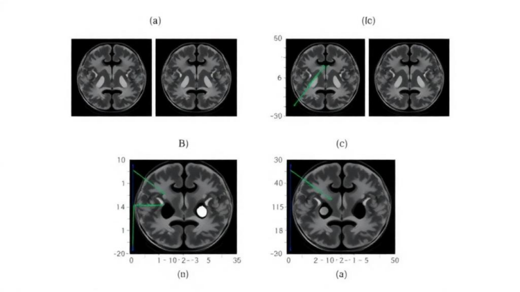Ensemble AI Reads Brain MRI With Adaptive Attention and Statistical Rigor