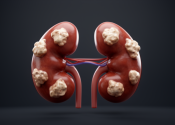 Review maps tumors linked to horseshoe kidney malformation