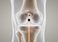 Simple notch check guides ACL graft tunnel within a millimetre on 3D imaging
