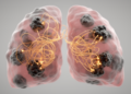 Long non-coding RNA TMPO-AS1 flags poor outcomes in lung adenocarcinoma