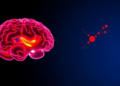 A Methylation Signature in Brain Fluid Predicts Who Survives a Deadly Stroke