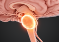 Rare Giant Notochordal Remnant Compresses Brainstem in 46-Year-Old Man
