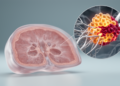 Prostate Cancer Study Links PSA Density and Nerve Invasion to Gleason Upgrading