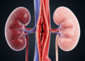 Reduced False Lumen Flow Near the Renal Arteries Emerges Early After Aortic Dissection Repair in Kidneys That Later Atrophy