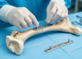 Double-Plate Fixation Shows Better Shoulder Stability in Retrospective Fracture Study